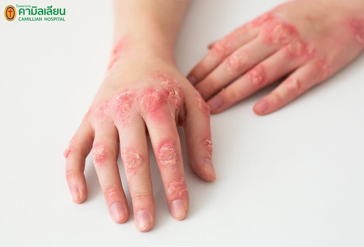 “โรคงูสวัด” เป็นแล้วต้องรักษา